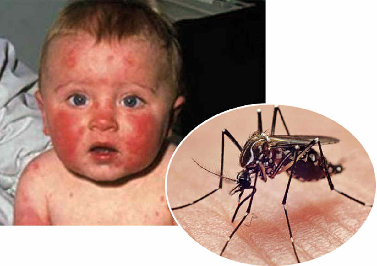 zica-virus-2